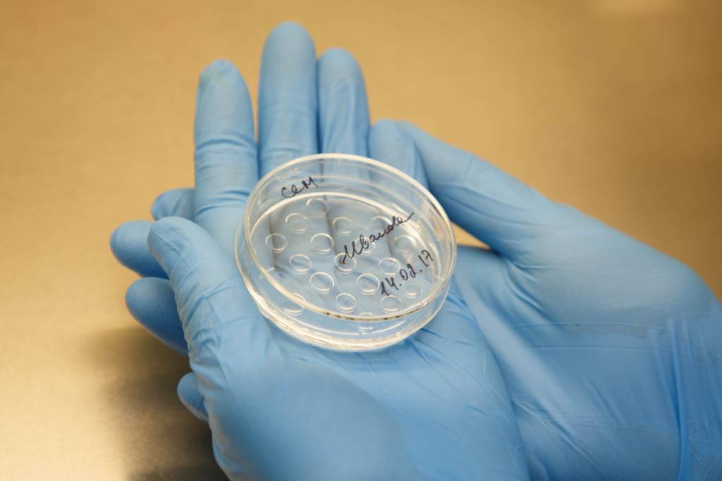 Редукция эмбриона при многоплодной беременности, саморедукция плода при двойне