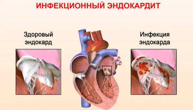 Причины врожденных пороков сердца у детей, симптомы и лечение, последствия