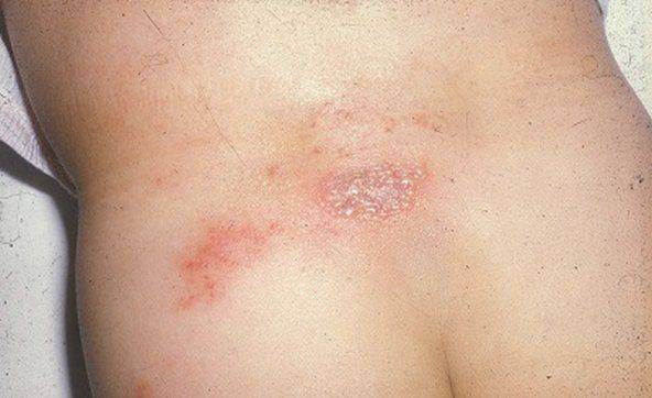 Герпес у детей: виды вируса, симптомы заболеваний, лечение и профилактика