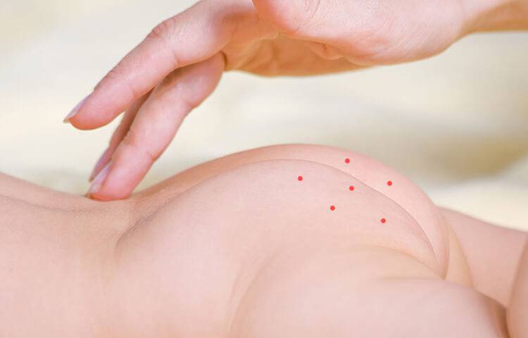 Сыпь у ребенка на попе - фото прыщей с пояснениями, причины аллергии и сухой кожи, лечение