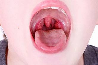 Бактериальная ангина у детей: симптомы и лечение, профилактика болезни