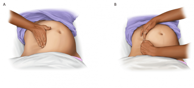 Эмболия околоплодными водами: что это такое, какие причины возникновения, как лечить?