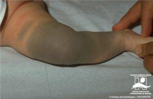 Монгольское пятно – причины и особенности большой родинки