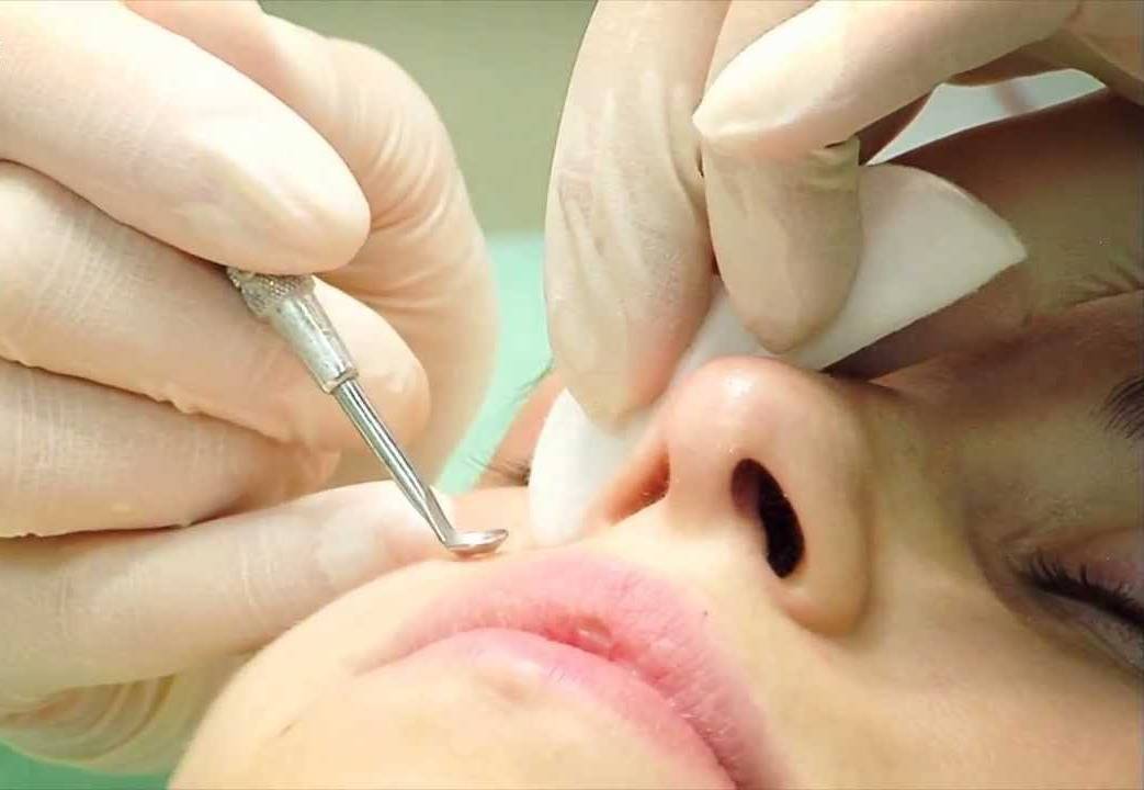 Подростковые прыщи у мальчиков и девочек: причины, лечение в домашних условиях