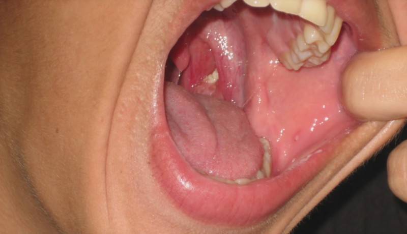 Красные точки во рту у ребенка - сыпь на слизистой неба и горла: фото с пояснениями