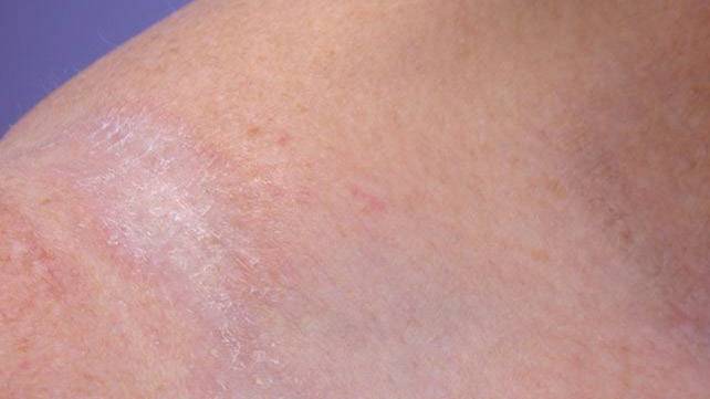 Шершавые пятна на теле у ребенка (на коже ног и рук, на спине и лице): фото