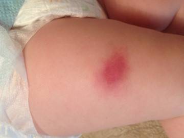 Интервал между прививками АКДС (Пентаксим): через сколько ставить вторую?