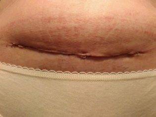 Спина болит после кесарева сечения: причины, способы избавления от боли