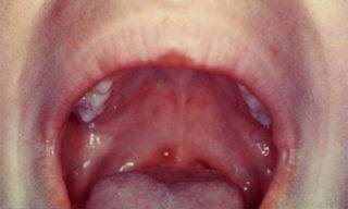 Ветрянка во рту у ребенка: чем обработать горло и язык, как полоскать ротовую полость?