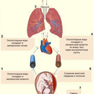 Эмболия околоплодными водами: что это такое, какие причины возникновения, как лечить?