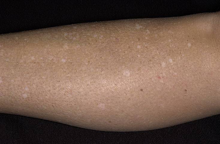 Причины появления у грудничков на коже шершавых, сухих пятен разного цвета