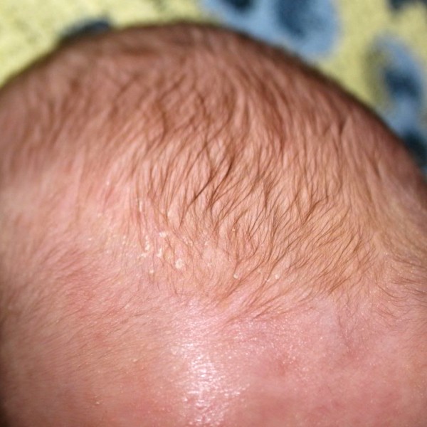 Впалый родничок у грудничка: причины западения темечка с фото