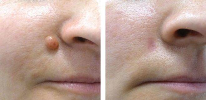 Когда у детей появляются родинки: в каком возрасте, можно ли удалять, к кому обратиться?