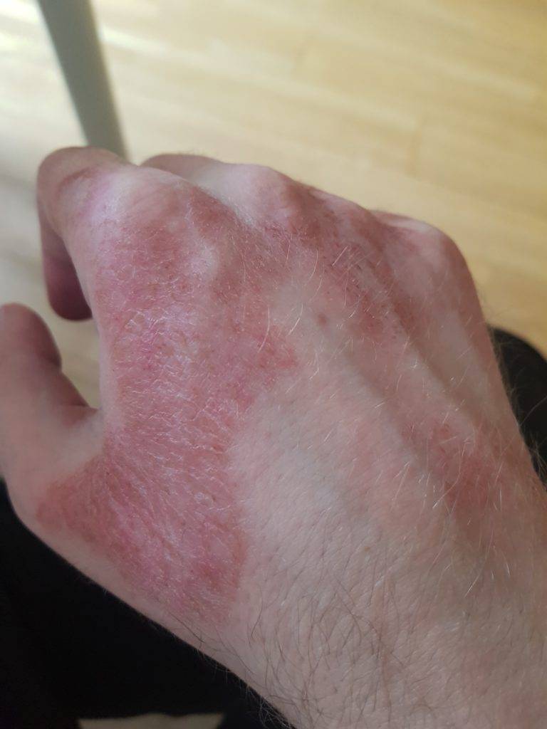 Шершавые пятна на теле у ребенка (на коже ног и рук, на спине и лице): фото