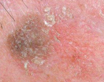 Шершавые пятна на теле у ребенка (на коже ног и рук, на спине и лице): фото