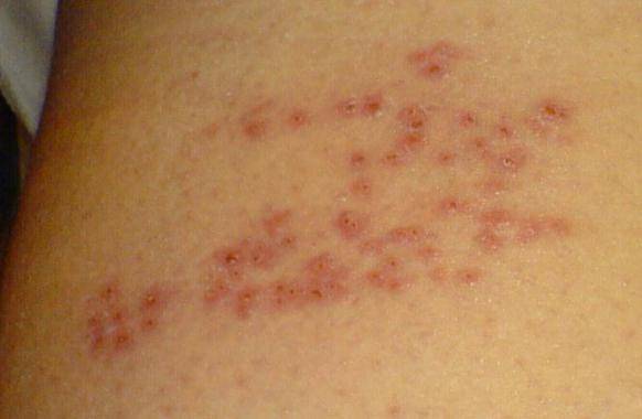 Лечение герпеса у детей: фото, виды, симптомы... | вирус герпес