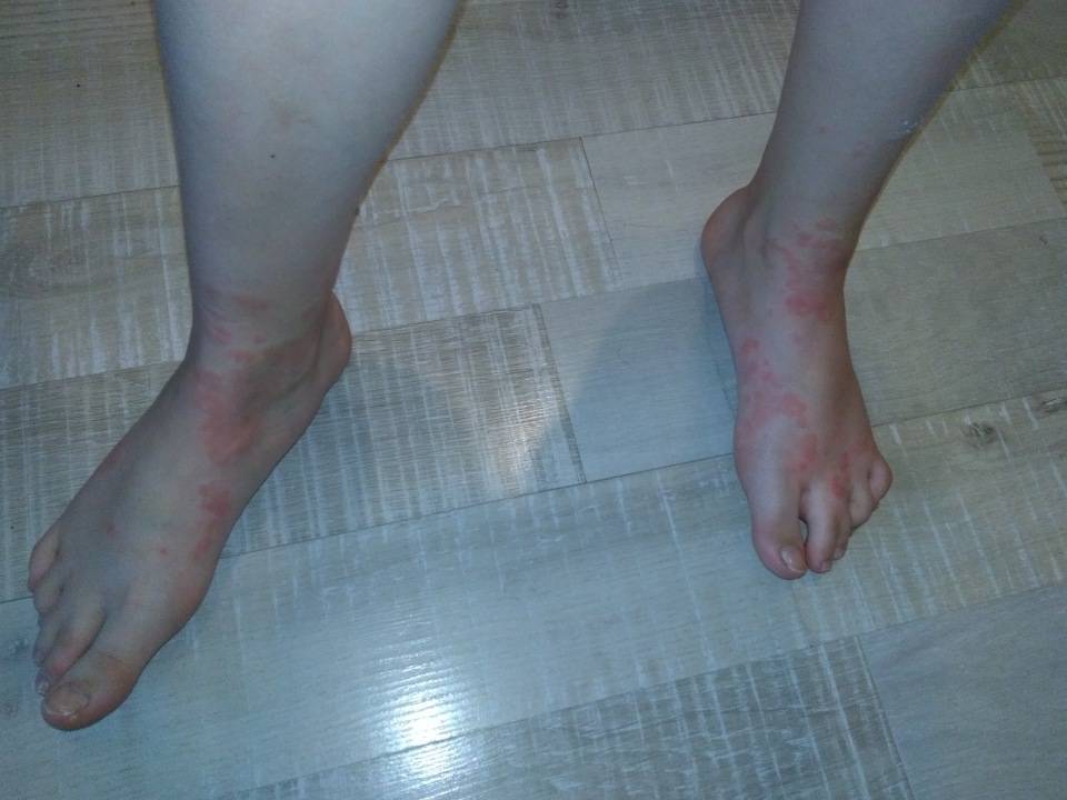 Шершавые пятна на теле у ребенка (на коже ног и рук, на спине и лице): фото