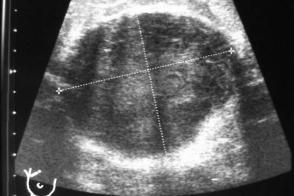 Ультразвук при лактостазе, физиотерапия: можно ли делать УЗИ при грудном вскармливании?