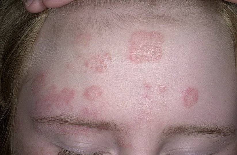 Лишай при беременности: влияние на плод, лечение, опасность во время вынашивания