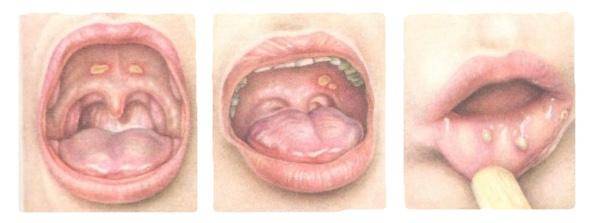 Стоматит у детей: симптомы с фото и лечение, первая помощь, профилактика болезни во рту