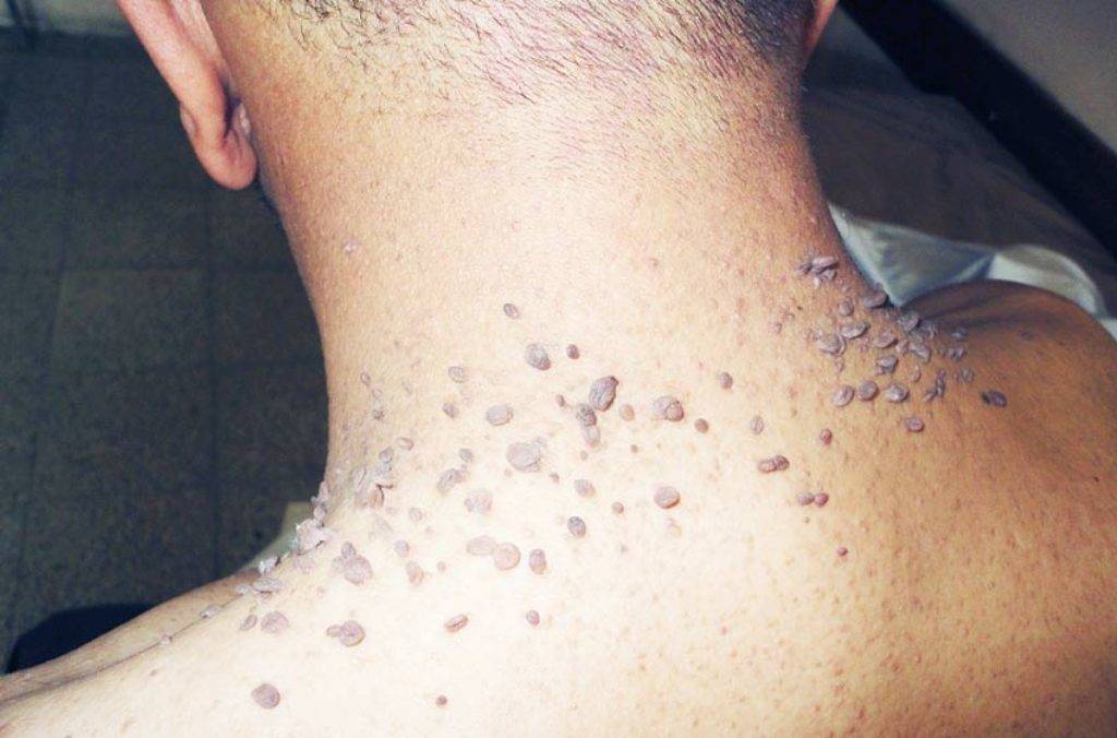 Как разводить Фурацилин в таблетках для промывания глаз детям при конъюнктивите и других патологиях?