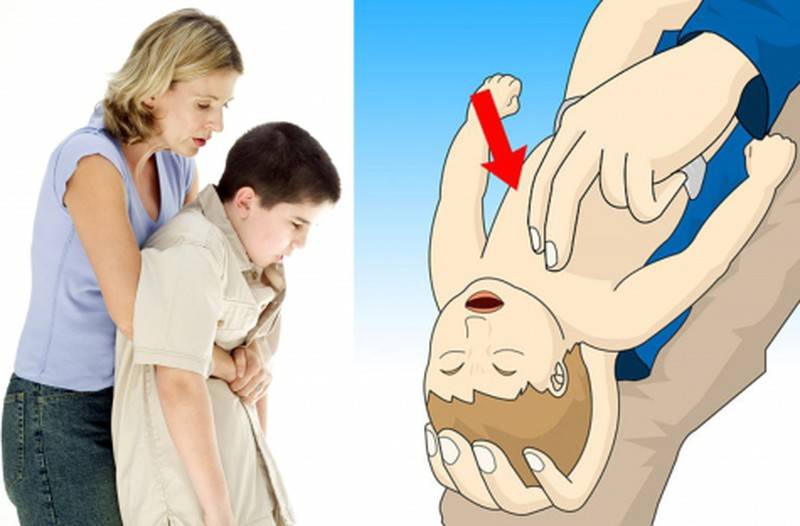 Что делать, если ребенок подавился и задыхается: первая помощь