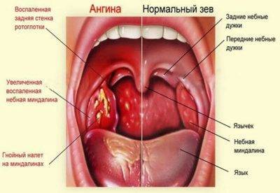 Как лечить горловой кашель у ребенка: медикаменты и народные средства