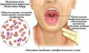 Вирус Эпштейна-Барра: симптомы у детей, ВЭБ анализ с расшифровкой и лечение