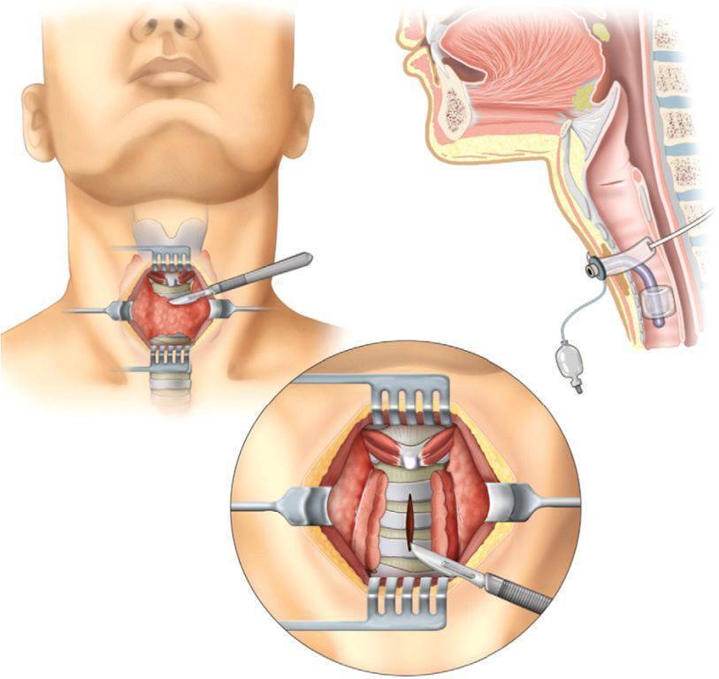 Дифтерия у детей: симптомы и лечение, профилактика, фото зева и гортани