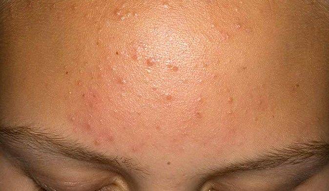 После родов прыщи на лице: почему появляются акне и сыпь и что делать?