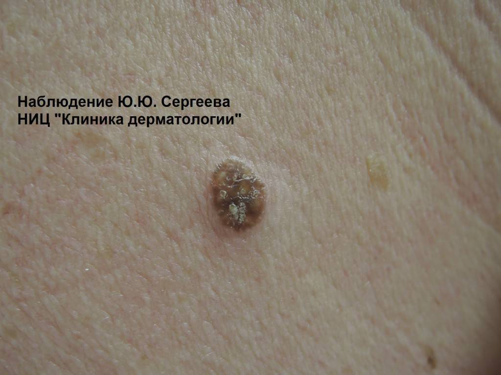 К какому врачу обратиться с родинками для удаления и если растет?