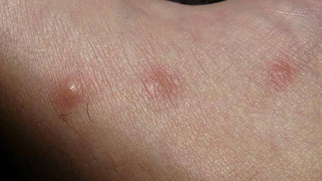 Мазь от укусов насекомых для детей: чем лечить опухоль и покраснение, как снять отек?