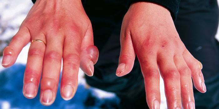 Гидрокортизоновая мазь: инструкция по применению для детей при лечении глаз