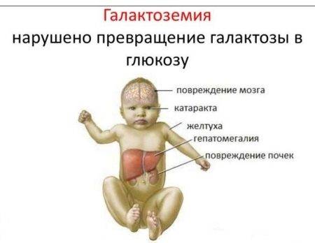 Неонатальный скрининг новорожденных в роддоме на наследственные заболевания (анализ крови из пятки)