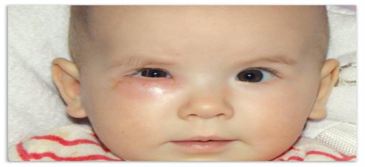 Дакриоцистит у новорожденных: лечение закупорки слезного канала каплями и промыванием