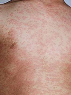 Псевдотуберкулез у детей: симптомы и лечение начальной и последующих стадий