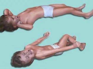 Судороги у ребенка при температуре: что делать - первая помощь при фебрильных судорогах