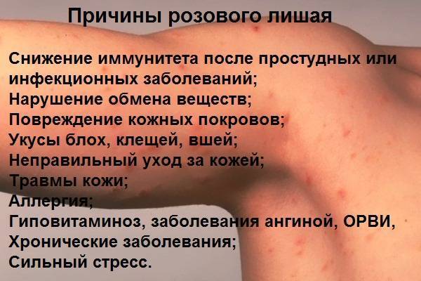 Розовый лишай у ребенка: фото, признаки и лечение в домашних условиях