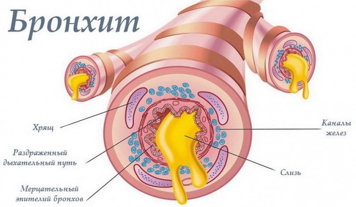 Лечение бронхита у детей народными средствами в домашних условиях