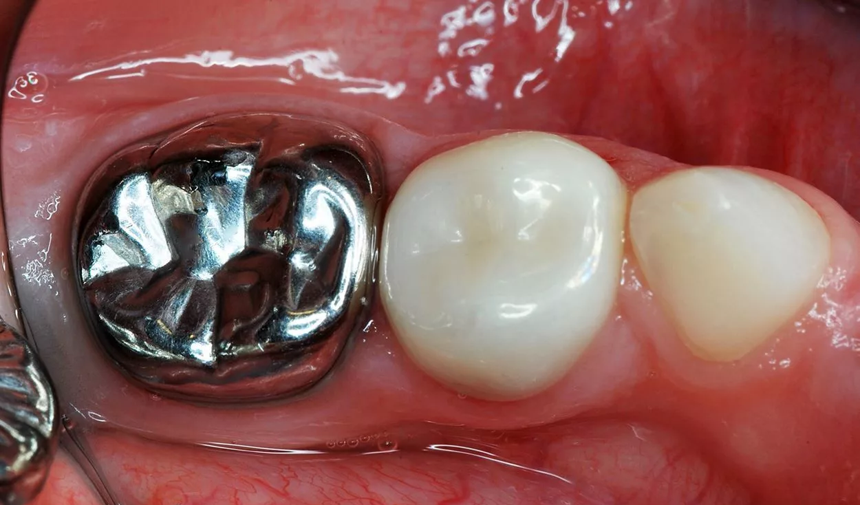 Серебрение молочных зубов у детей: фото процедуры, отзывы родителей, преимущества процедуры