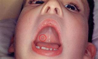 Ветрянка во рту у ребенка: чем обработать горло и язык, как полоскать ротовую полость?