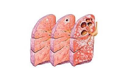 Признаки туберкулеза у детей - первые симптомы, лечение на ранних стадиях, профилактика