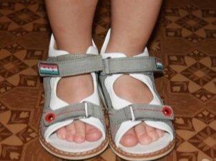 Варусная деформация стопы у детей ???? - фото и симптомы, способы лечения, подбор обуви
