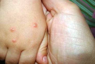 Контагиозный моллюск у детей: фото на коже, лечение и удаление на разных стадиях болезни