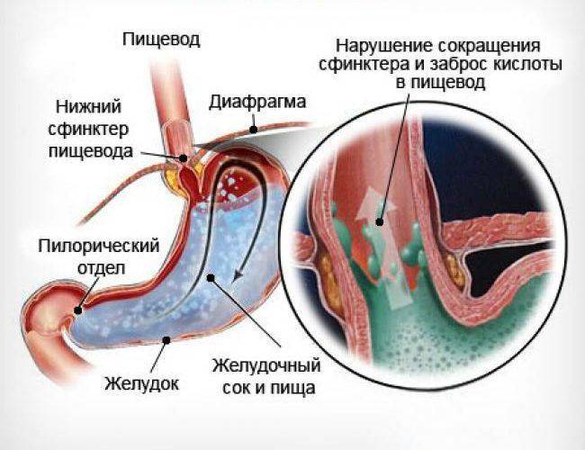 Кислота во рту при беременности: почему возникает неприятный привкус на ранних сроках, что делать?