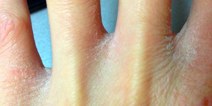 Чешется кожа ладоней: возможные причины зуда и шелушения рук, медикаментозные и народные методы лечения