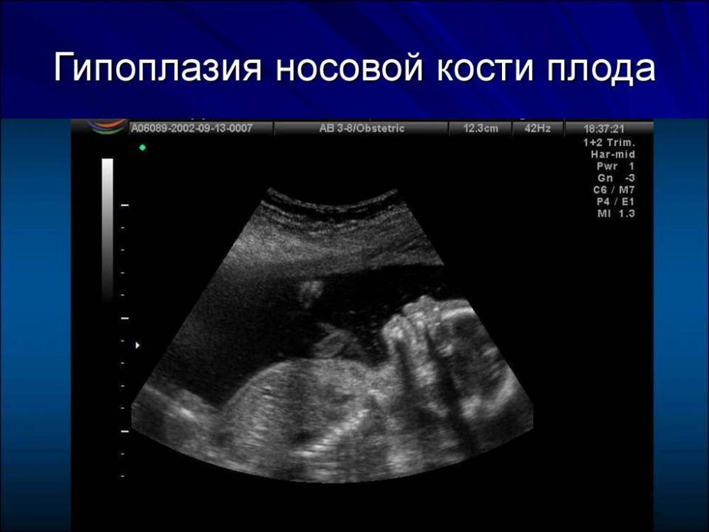 Толщина воротникового пространства в 12 недель: норма, таблица, отклонения