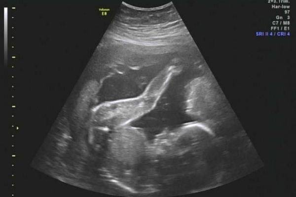 УЗИ на 34 неделе беременности: показатели нормы у плода и будущей матери