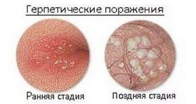 Эритроциты, лецитиновые зерна и клетки эпителия в спермограмме: что это означает?