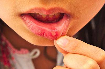 Стоматит в горле у ребенка (с фото): способы лечения язвочек на миндалинах